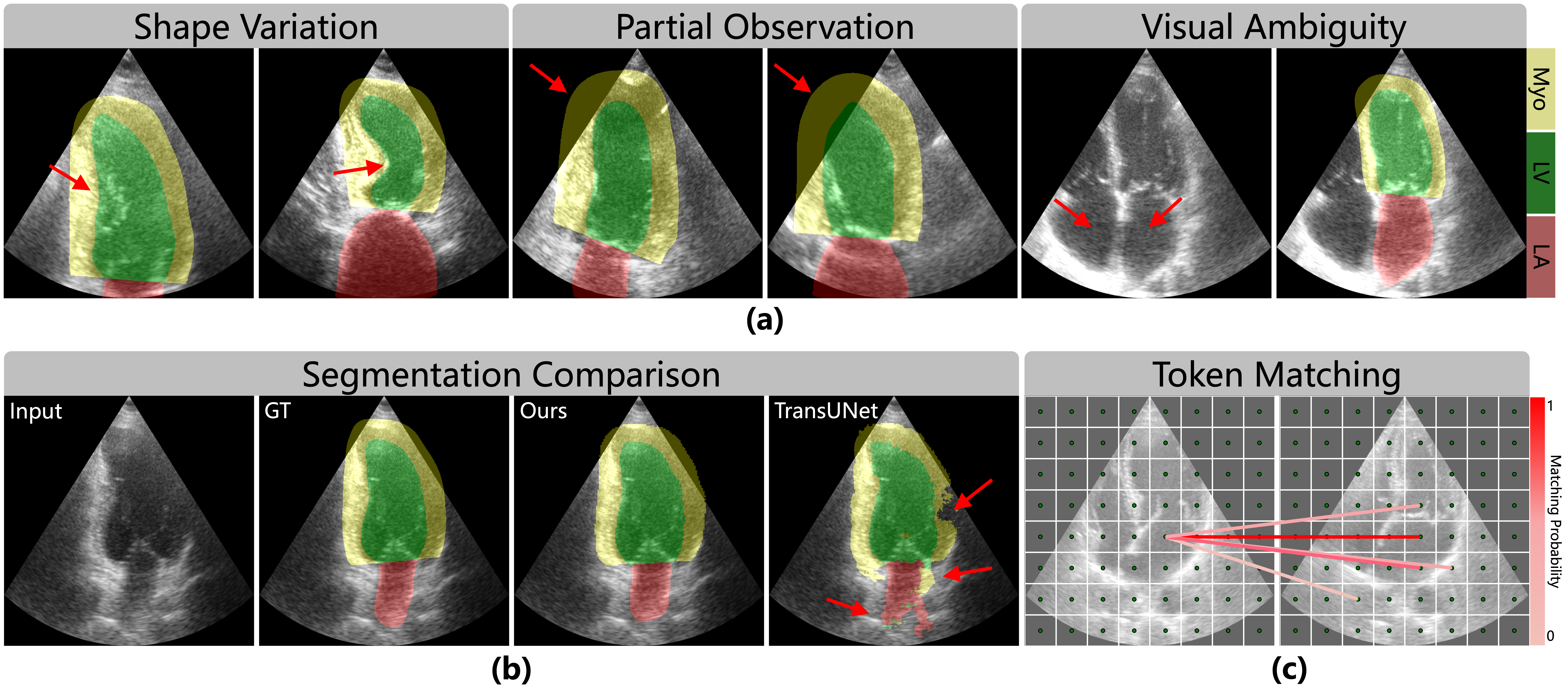 BOTM teaser: echocardiography segmentation with anatomical consistency